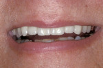 Figure 11  Based on their masking ability, strength, and ease of cementation, alumina crowns were selected for the final restorations.