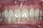 Figure 12  The final restorations were seated using resin-reinforced glass ionomer cement.