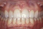 Figure 15  The final bridge and veneer restorations were seated using composite resin cement according to a dentin bonding protocol.