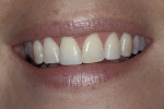 Figure 16  A 38-year-old patient presented to the office following a traumatic injury to her anterior teeth.