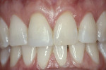 Figure 17  A 38-year-old patient presented to the office following a traumatic injury to her anterior teeth.