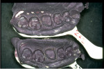 Figure 1  Tray bleed-through on the palatal side indicates the potential for distortion (image courtesy of DENTSPLY Caulk).