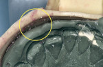 Figure 2 Inadequate or improper tray adhesive allows uncontrolled shrinkage of material and distortion (image courtesy of DENTSPLY Caulk).