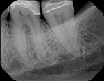 Preoperative periapical radiograph showing no signs of apical pathosis.