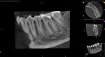 Preoperative CBCT image demonstrating evidence of apical periodontal ligament widening localized to tooth No. 19. This aided in the diagnosis of pulpal necrosis with symptomatic apical periodontitis in tooth No. 19 as the source of the patient’s severe facial pain.