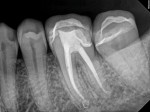 Posttreatment radiograph following the performance of nonsurgical root canal therapy on tooth No. 19, which successfully resolved the patient’s pain.