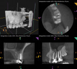 Preoperative sagittal and axial CBCT images of tooth No. 14 showing an asymptomatic periapical pathosis and localized maxillary sinus mucositis secondary to an untreated second mesiobuccal canal.