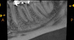 CBCT imaging of tooth No. 19 also demonstrated an apical pathosis, but it was symptomatic and accompanied by pulpal necrosis that was determined to be the cause of the patient’s severe pain.