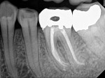 Posttreatment radiograph following the completion of nonsurgical root canal therapy on tooth No. 19. The treatment completely resolved the patient’s pain.