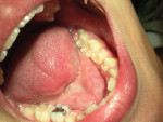 Pretreatment photograph of partially erupted mandibular second permanent molars.