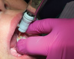 The sealant was immediately applied to the fissures of the left-side mandibular second permanent molar with a capsule applicator.