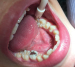 Posttreatment photograph taken after the procedure was repeated for the contralateral molar.