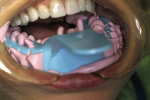 Figure 4  The viscosity has the look and feel of conventional alginate, and the material displaces the cheek and tongue to capture the important aspects of the oral anatomy.
