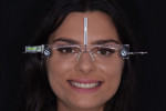 Fig 2. Facial reference glasses were used to align the patient’s horizontal and vertical planes.