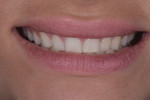 Fig 4. Pretreatment close-up, left lateral, and right lateral views of the patient’s smile. Her low-lip smile line and retroclined maxillary teeth left adequate room to add length to teeth Nos. 4 through 13, fill the frame of her smile, and fill her upper lip and flange area.