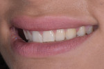 Fig 5. Pretreatment close-up, left lateral, and right lateral views of the patient’s smile. Her low-lip smile line and retroclined maxillary teeth left adequate room to add length to teeth Nos. 4 through 13, fill the frame of her smile, and fill her upper lip and flange area.