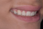 Fig 6. Pretreatment close-up, left lateral, and right lateral views of the patient’s smile. Her low-lip smile line and retroclined maxillary teeth left adequate room to add length to teeth Nos. 4 through 13, fill the frame of her smile, and fill her upper lip and flange area.