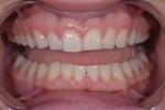 Fig 7. Pretreatment close-up retracted views of the patient’s smile revealed chipped teeth from a sports injury and worn maxillary teeth from a parafunctional grinding habit.