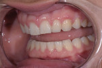 Fig 8. Pretreatment close-up retracted views of the patient’s smile revealed chipped teeth from a sports injury and worn maxillary teeth from a parafunctional grinding habit.