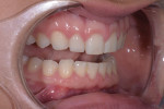 Fig 9. Pretreatment close-up retracted views of the patient’s smile revealed chipped teeth from a sports injury and worn maxillary teeth from a parafunctional grinding habit.