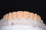 Fig 10. The diagnostic wax-up designed and fabricated by the dental laboratory created an ideal contour and length for the no-preparation veneers.