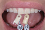 Fig 11. A shade tab photograph provided the laboratory with the patient’s natural tooth color to help achieve the desired bleach shade of the final restorations.