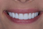 Fig 14. Post-treatment close-up smile, full-face smile, and profile photographs of the composite temporary restorations.