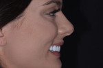 Fig 16. Post-treatment close-up smile, full-face smile, and profile photographs of the composite temporary restorations.