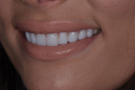 Fig 18. Post-treatment close-up smile, left lateral, and right lateral, photographs of the final prepless lithium disilicate veneers.