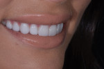 Fig 19. Post-treatment close-up smile, left lateral, and right lateral, photographs of the final prepless lithium disilicate veneers.