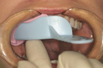 Figure 8  Silginat impression, with bis-Acrylic provisional material, being reseated in the mouth.