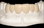 Figure 1b  Wax-up of corrected dentition.