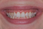 Fig 2. Pretreatment close-up view of smile. Heavy biofilm deposits and gingival inflammation were evident.