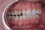 Fig 3. The restoration covering tooth No. 6 was poorly shaped and discolored.