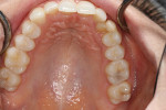 Fig 4. Pretreatment occlusal view showing the contours of the cantilevered restoration, which prevented flossing and was a food trap.
