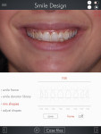 Fig 6. The digital smile design 2D smile.