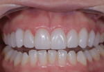 Fig 16. Post-treatment view with teeth apart.