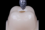 Fig 1. Preparation of a 2.5 mm access hole in the center of the crown.