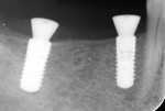 Fig 2. Radiograph of implants properly placed for the replacement of teeth Nos. 29 and 31.