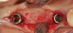 Fig 5. Crestal incision, buccal and lingual tissue reflection, and bone preparation to receive ovate pontic.