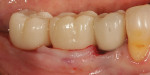 Fig 6. Provisional fully seated in place. Buccal and lingual keratinized tissue flaps were supported by ovate pontic.
