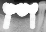 Fig 12. Final radiograph with final bony contours under the ovate pontic.