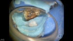 Fig 1. Post-GentleWave Procedure. Triple tray impression taken, all caries removed, SoundSeal™ used as a custom resin matrix to accommodate a dual-cure composite resin core.