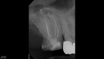 Fig 3. Post–GentleWave Procedure. Final radiographic result demonstrating minimal to no shape imparted to the canals. Non-instrumentation performed in the palatal (P) root and minimal shaping to a 17.04 V-taper in all other canals. Single-cone and BC sealer technique used to obturate the mesiobuccal (MB), distobuccal (DB), and P canals. System S warm gutta percha technique used to obturate the MB2 canal.