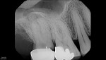 Fig 4. Pre–GentleWave Procedure. Recurrent caries noted under the existing restoration with findings suggestive of periapical pathology noted.
