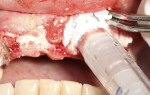 Fig 8. Placement of Bond Apatite to fill the buccal defect to create adequate thickness of the ridge for implant placement upon graft healing.