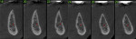 Fig 11. CBCT cross-sections of the posterior mandible demonstrating knife edge crest at planned implant sites.