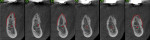 Fig 14. CBCT cross-sections 4 months postsurgery demonstrating increase in ridge width to allow implant placement.