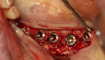 Fig 15. After allowing 4 months for graft healing and bone maturation, implants were placed into the healed graft site.