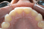Figure 2  The appearance of palatal dental erosion.